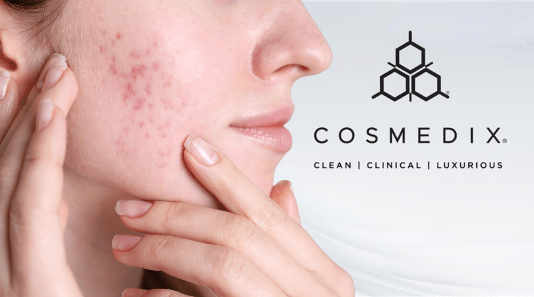 Adult Acne Without Irritation: A Barrier-First Treatment Plan - C O S M E D I X