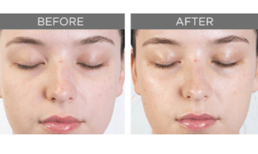 Chemical Exfoliants 101 with Pure Enzymes - C O S M E D I X