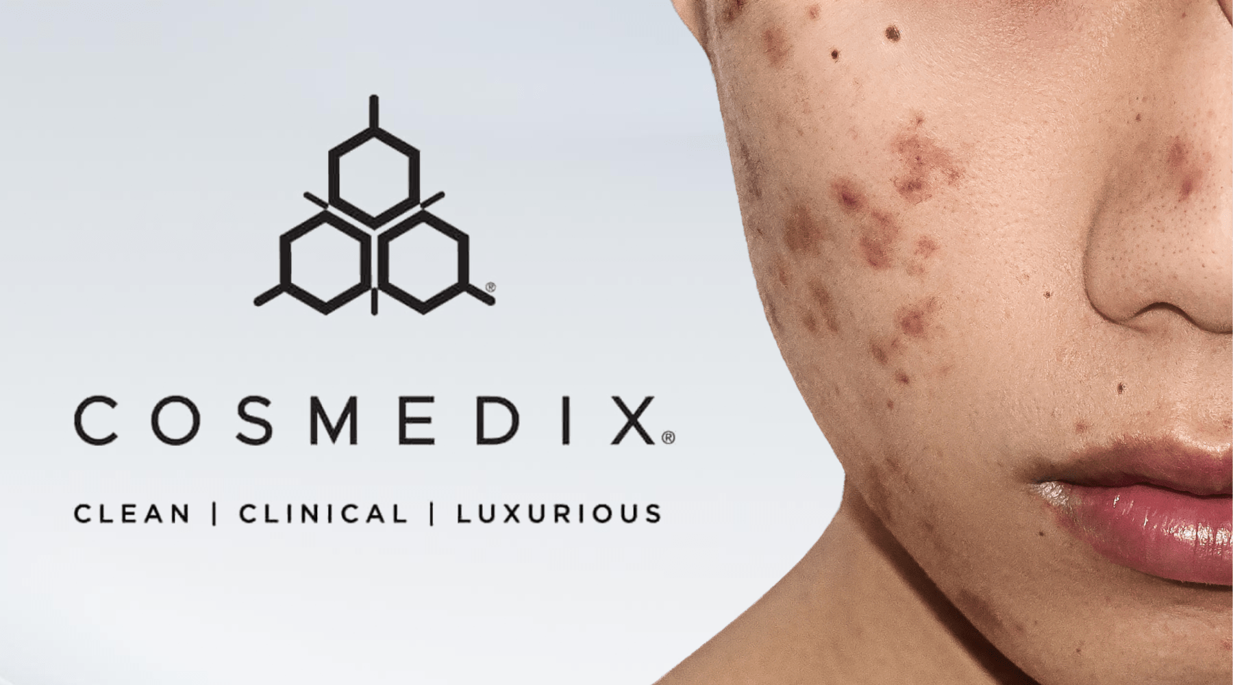 Cyclic Adult Acne in Hot Weather: A Low-Irritation Protocol - C O S M E D I X