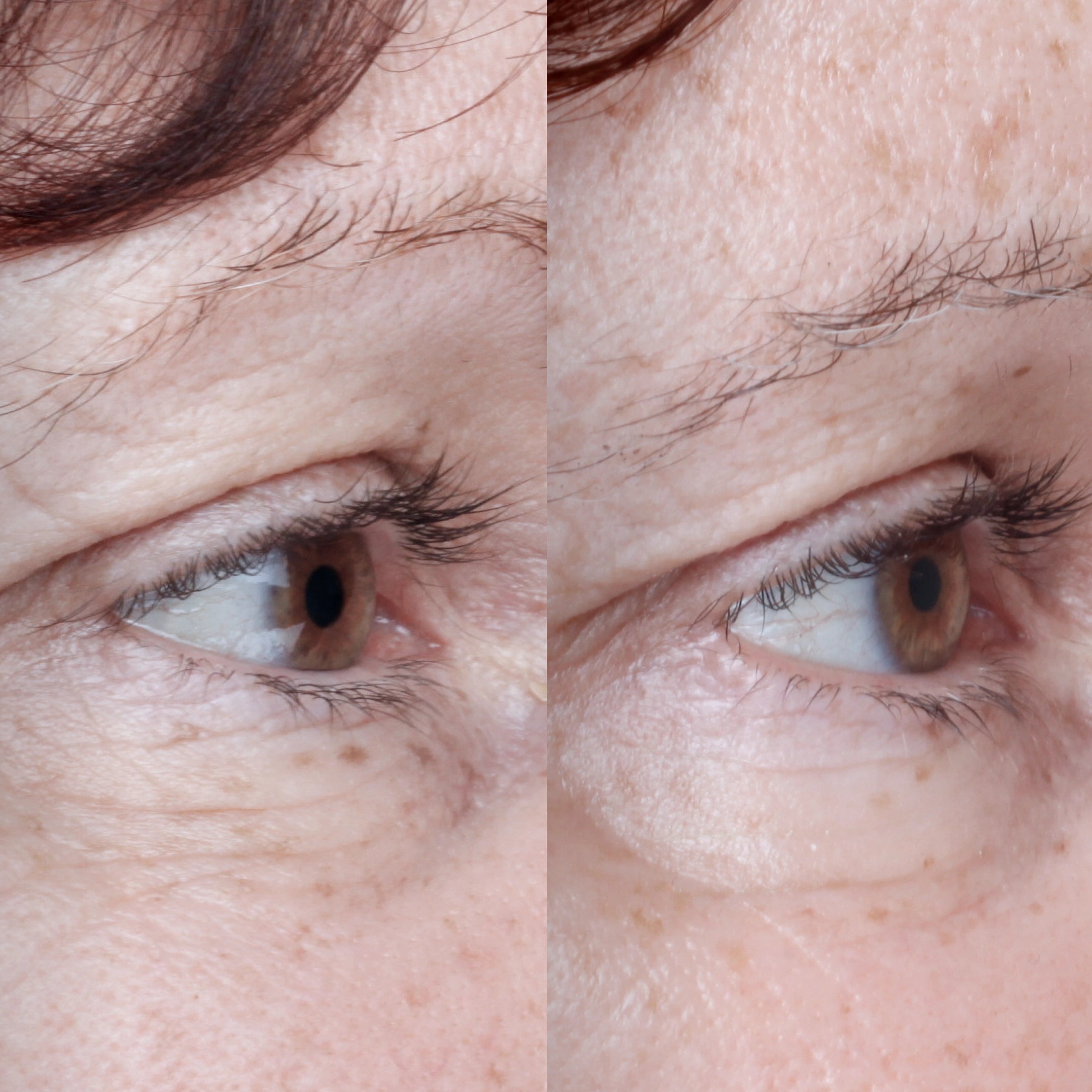 Opti's Before and after comparison of a person's eye area with visible aging signs.