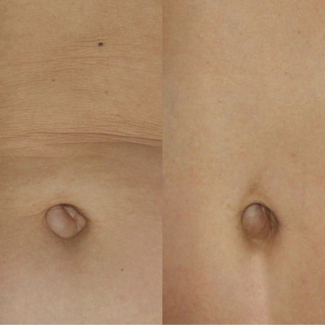 A-Lift's Before and after comparison of a person's stomach with text indicating recovery time.