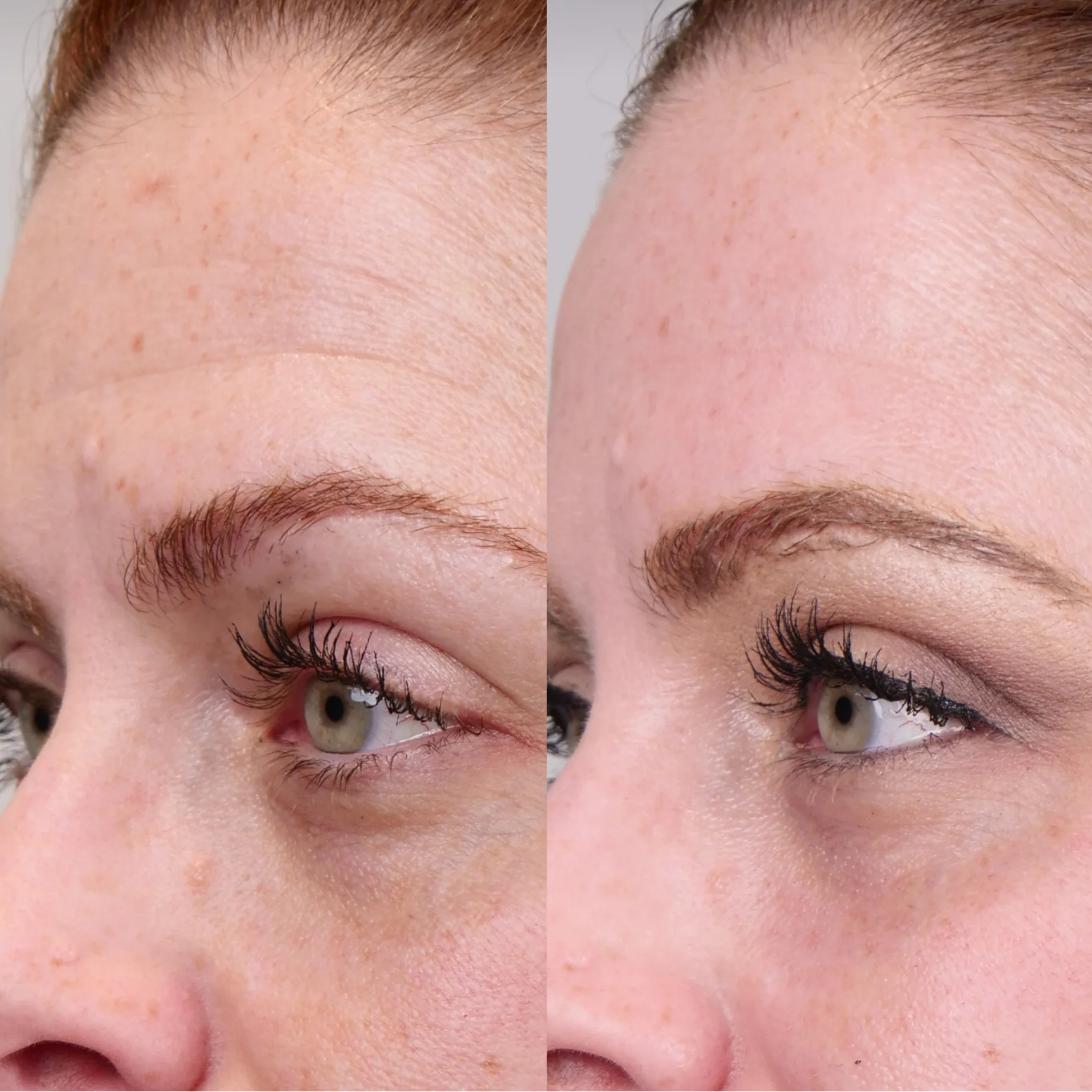 Duo-A's Before and after close-ups of temple skin showing improvement after four weeks using DUO-A